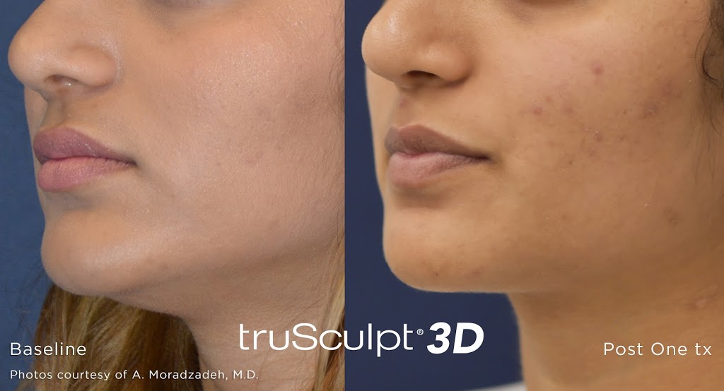 Smooth Laser Clinic and Body Sculpting | 14885 60 Ave #6, Surrey, BC V3S 1R8, Canada | Phone: (604) 593-5578