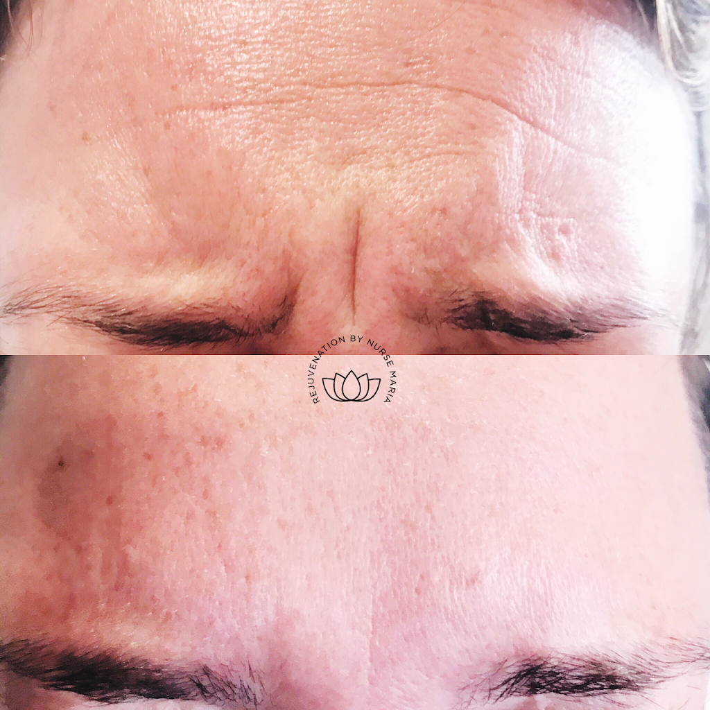 New Tec Cosmetic Rejuvenation | 35 Wolfe Ave Tottenham L0G1W0, 100 Bass Pro Mills Dr Unit 42, Vaughan, ON L4K 5X1, Canada | Phone: (416) 605-3646