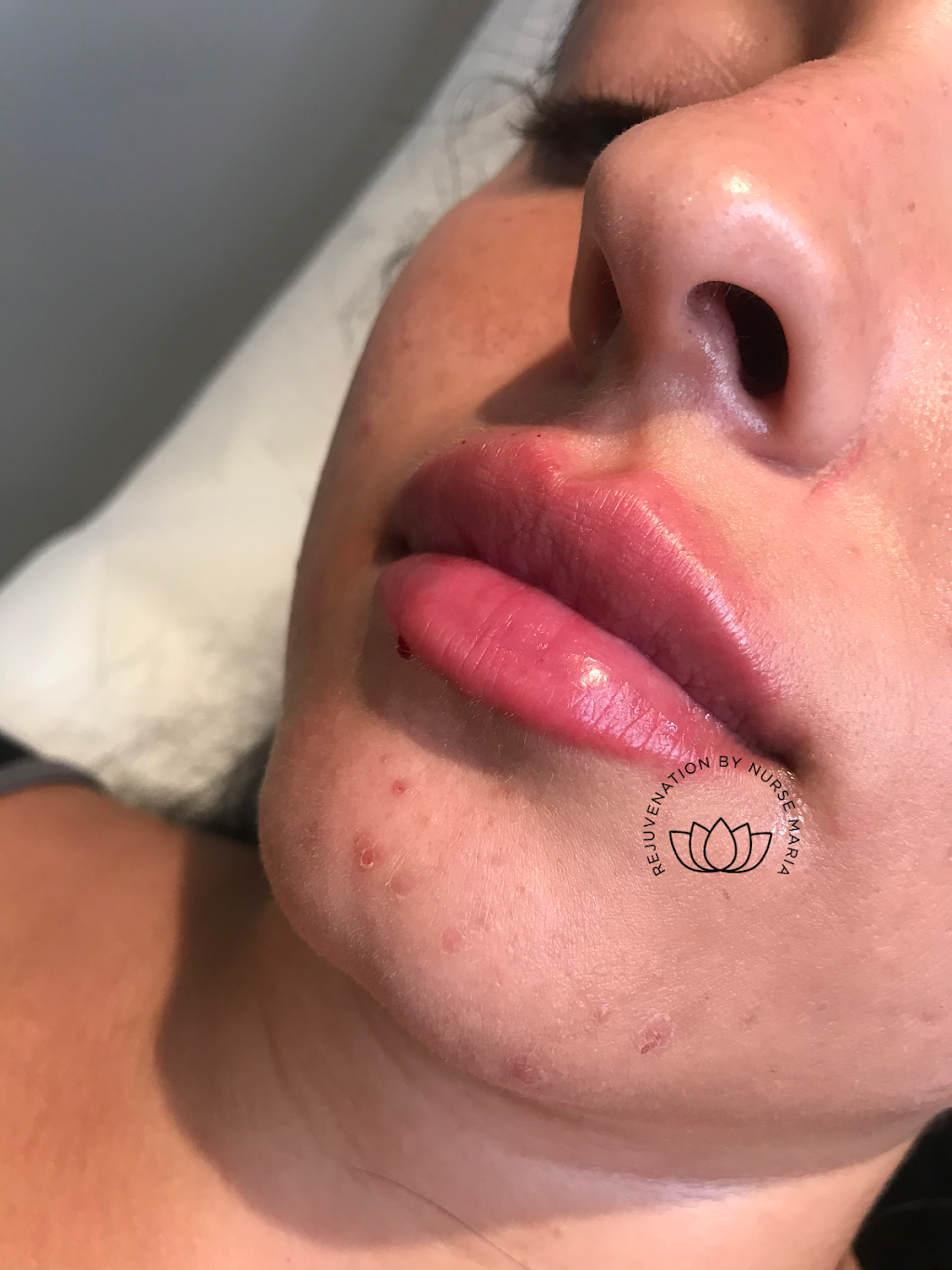 New Tec Cosmetic Rejuvenation | 35 Wolfe Ave Tottenham L0G1W0, 100 Bass Pro Mills Dr Unit 42, Vaughan, ON L4K 5X1, Canada | Phone: (416) 605-3646