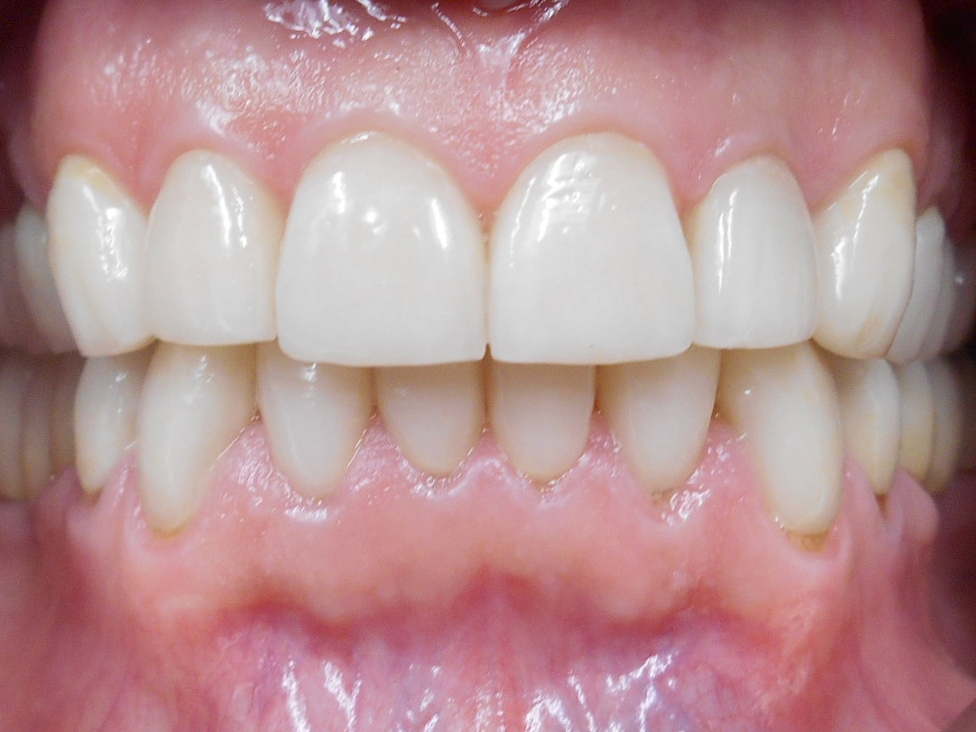 Excalibur Dental Lab Inc. | Glen Abbey, Oakville, ON L6M 2V6, Canada | Phone: (905) 847-3499