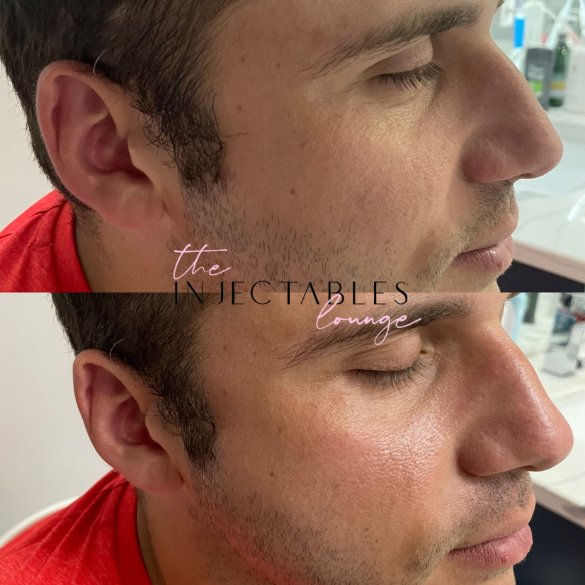 The Injectables Lounge | 190 Wortley Rd Unit 100C, London, ON N6C 4Y7, Canada | Phone: (226) 237-7446