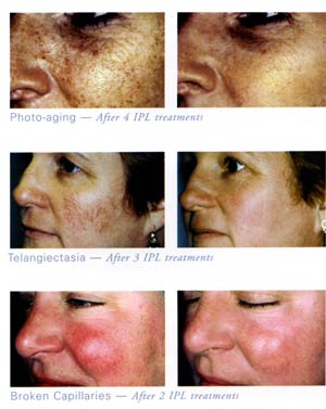 The Laser Room Medi-Spa & Piercing Studio | 2091 20 St NE, Salmon Arm, BC V1E 2G3, Canada | Phone: (250) 253-2885