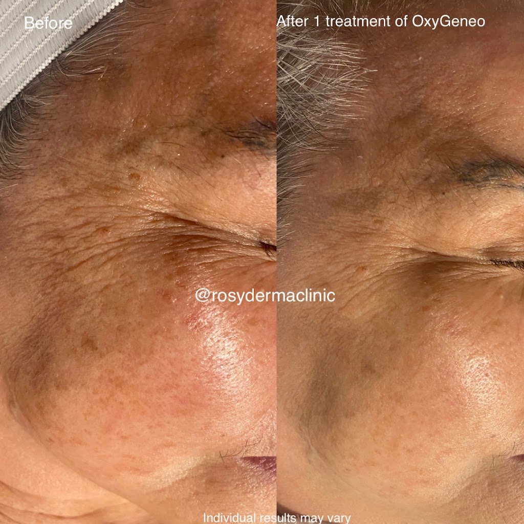 Rosy Derma Clinic | 51 Hawktree Ridge, Nepean, ON K2J 5N7, Canada | Phone: (613) 262-8929