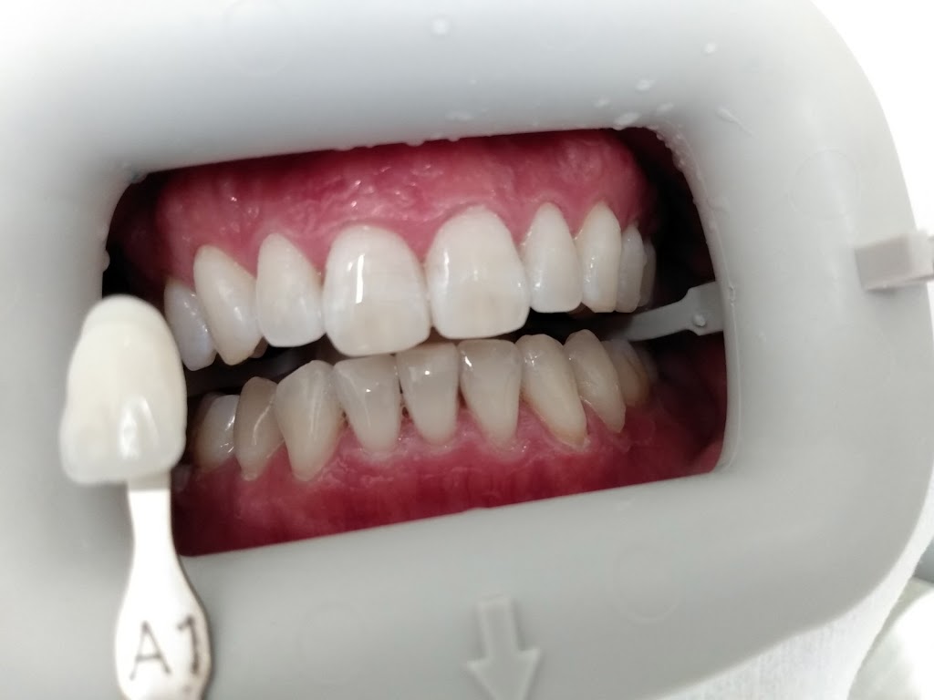Zoom Dental Burnaby | 6968 Royal Oak Ave #105, Burnaby, BC V5J 4J3, Canada | Phone: (604) 258-0392