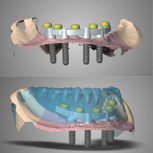 Beaumont Denture & Implant Clinic - Curtis Marusiak (Denturist) | Suite 201, 5305 Magasin Ave 2nd Floor, Beaumont, AB T4X 1V8, Canada | Phone: (780) 929-1465