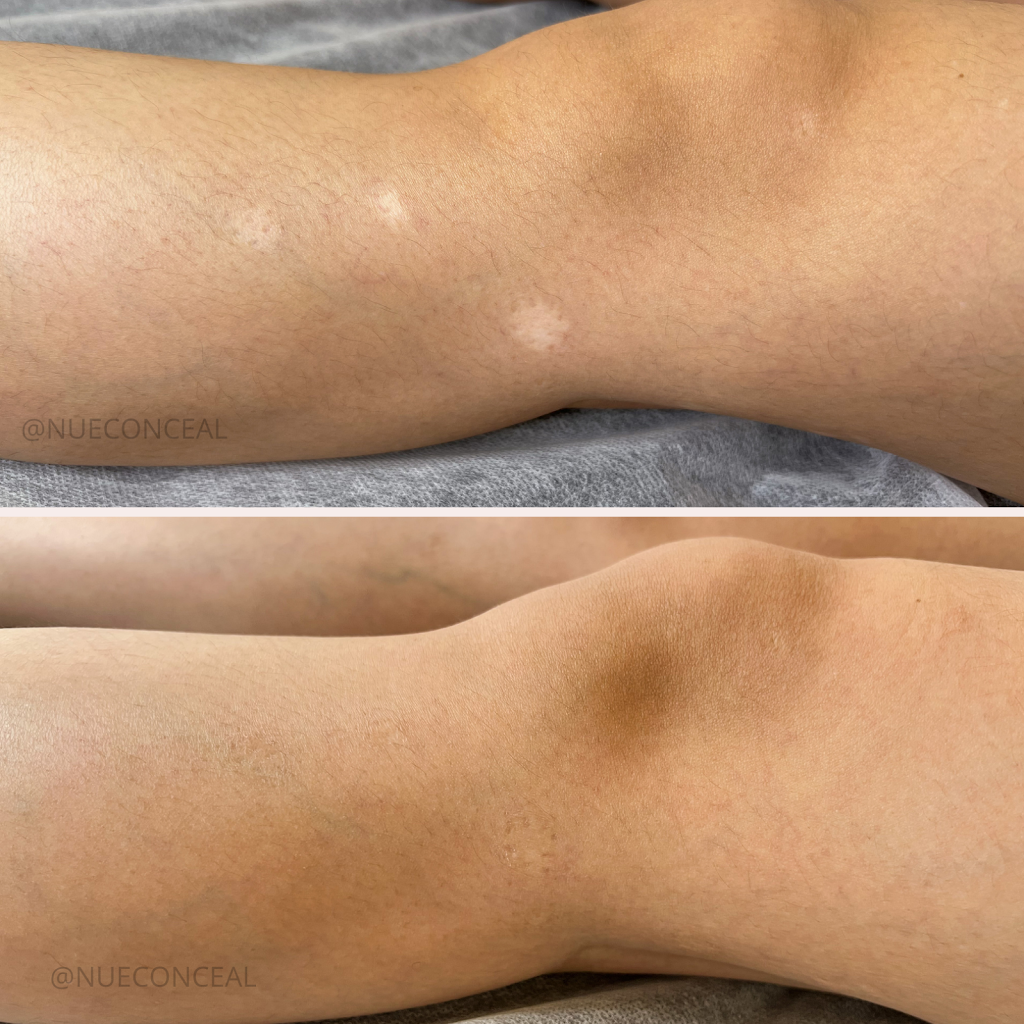 Efface Skin Care Clinic Inc. | 72 King St W, Stoney Creek, ON L8G 1H8, Canada | Phone: (905) 745-4097