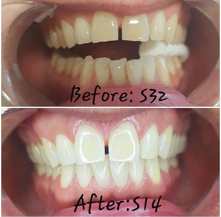 Ottawa Teeth Whitening | 2742 St Joseph Blvd #10, Orléans, ON K1C 1G5, Canada | Phone: (613) 808-9344