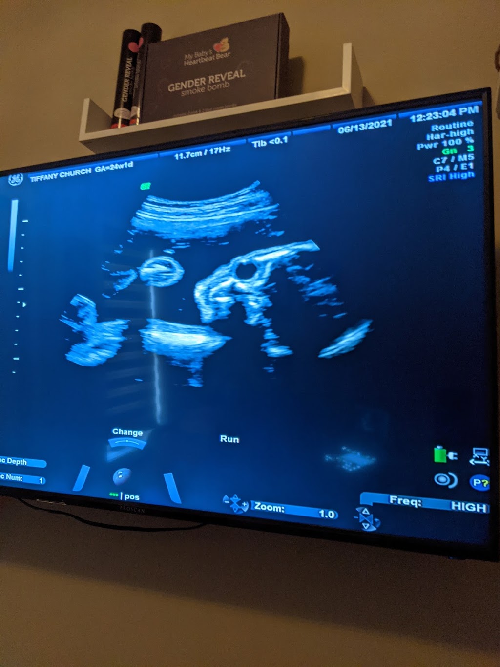 Prenatal Peek 3D4D Ultrasound | 98 Golden Boy Ln, Winnipeg, MB R3W 0L9, Canada | Phone: (204) 791-5861