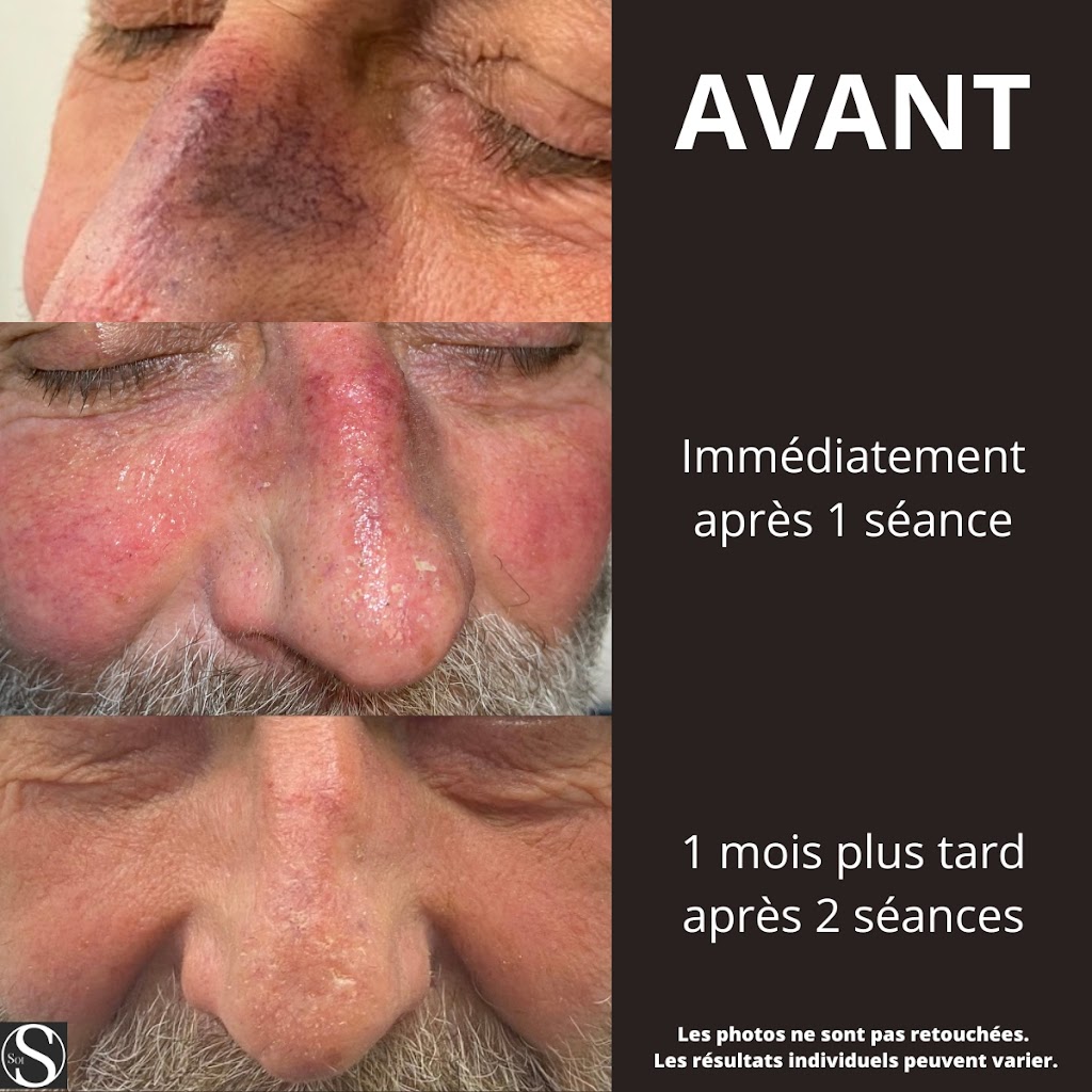 Soi Centre médico esthétique | 125 Chem. Saint-François-Xavier suite 103, Candiac, QC J5R 3X8, Canada | Phone: (450) 638-6363