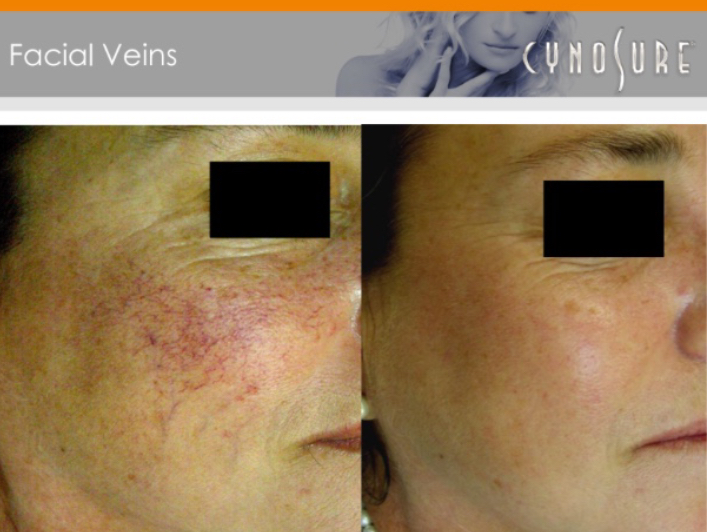 Niya Laser Spa | 1295 Wharf St #10, Pickering, ON L1W 1A4, Canada | Phone: (416) 545-7997
