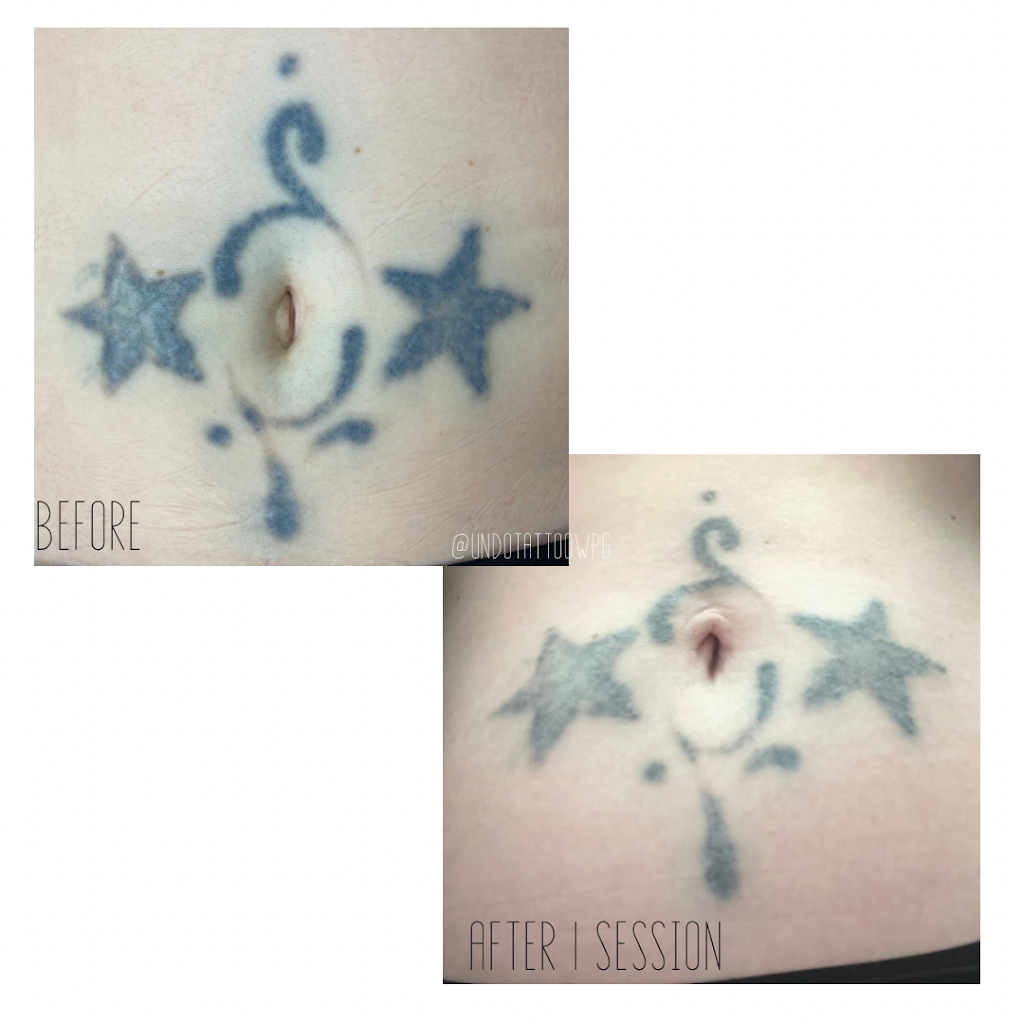 Undo Tattoo Laser Tattoo Removal | 169 Marion St, Winnipeg, MB R2H 0T3, Canada | Phone: (204) 558-8636