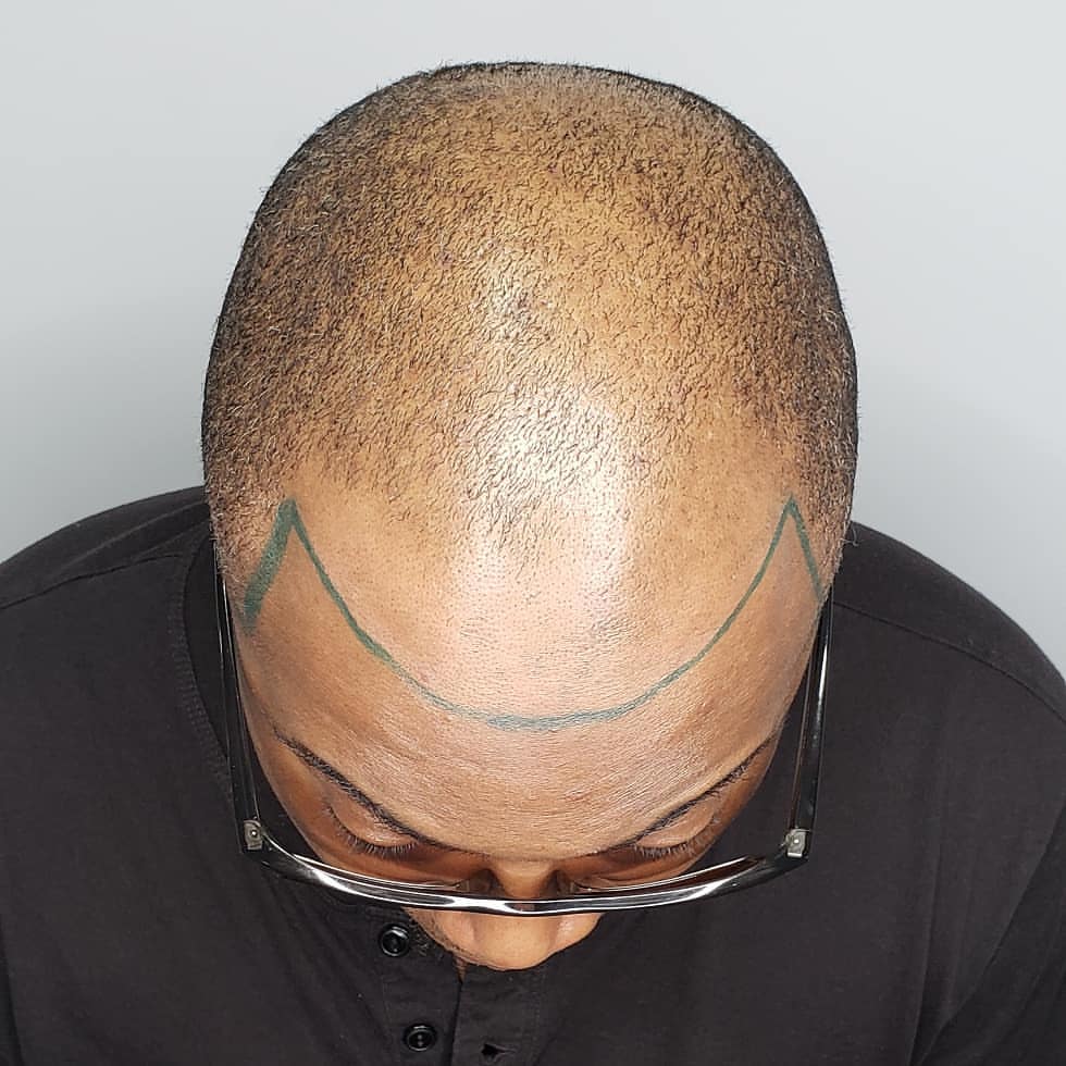 Scalp Micropigmentation by Chronic Ink - Markham | 7381 Kennedy Rd Unit #105, Markham, ON L3R 5B5, Canada | Phone: (905) 305-0311