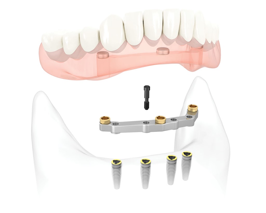 Beaumont Denture & Implant Clinic - Curtis Marusiak (Denturist) | Suite 201, 5305 Magasin Ave 2nd Floor, Beaumont, AB T4X 1V8, Canada | Phone: (780) 929-1465