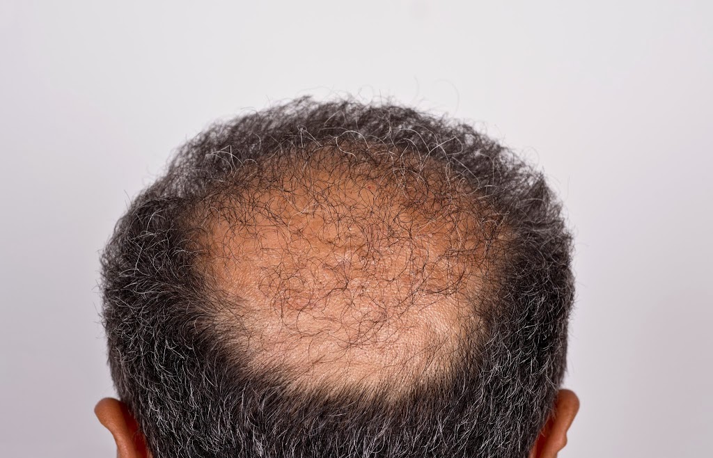Canadian Hair Transplant Centre | 2863 Ellesmere Rd Suite #405, Scarborough, ON M1E 4B9, Canada | Phone: (416) 924-2482