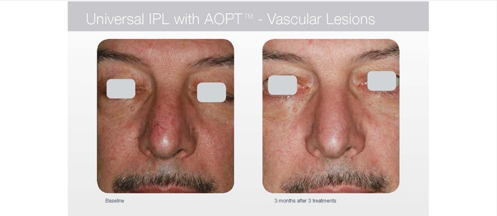 Beautique Laser Spa | 398 Steeles Ave W Unit #3, Thornhill, ON L4J 6X3, Canada | Phone: (416) 877-4348