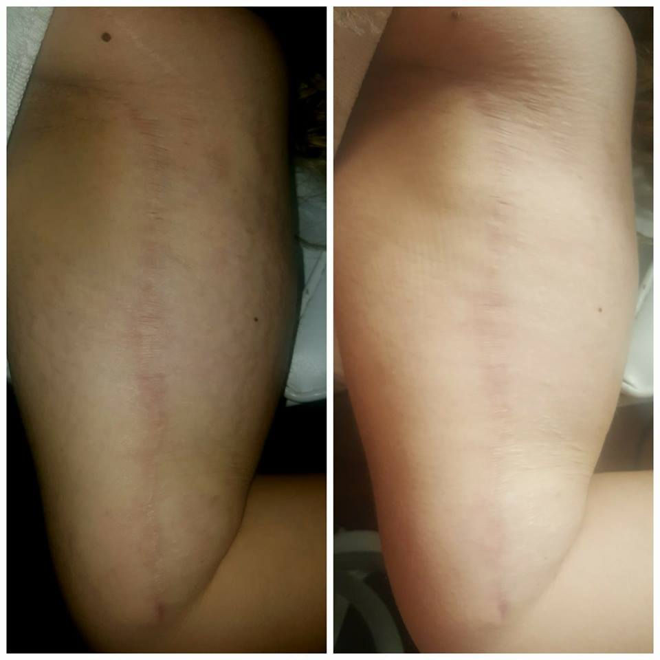 ProLaser | 1225 Stanley St, Windsor, ON N8X 4Z9, Canada | Phone: (519) 819-5296