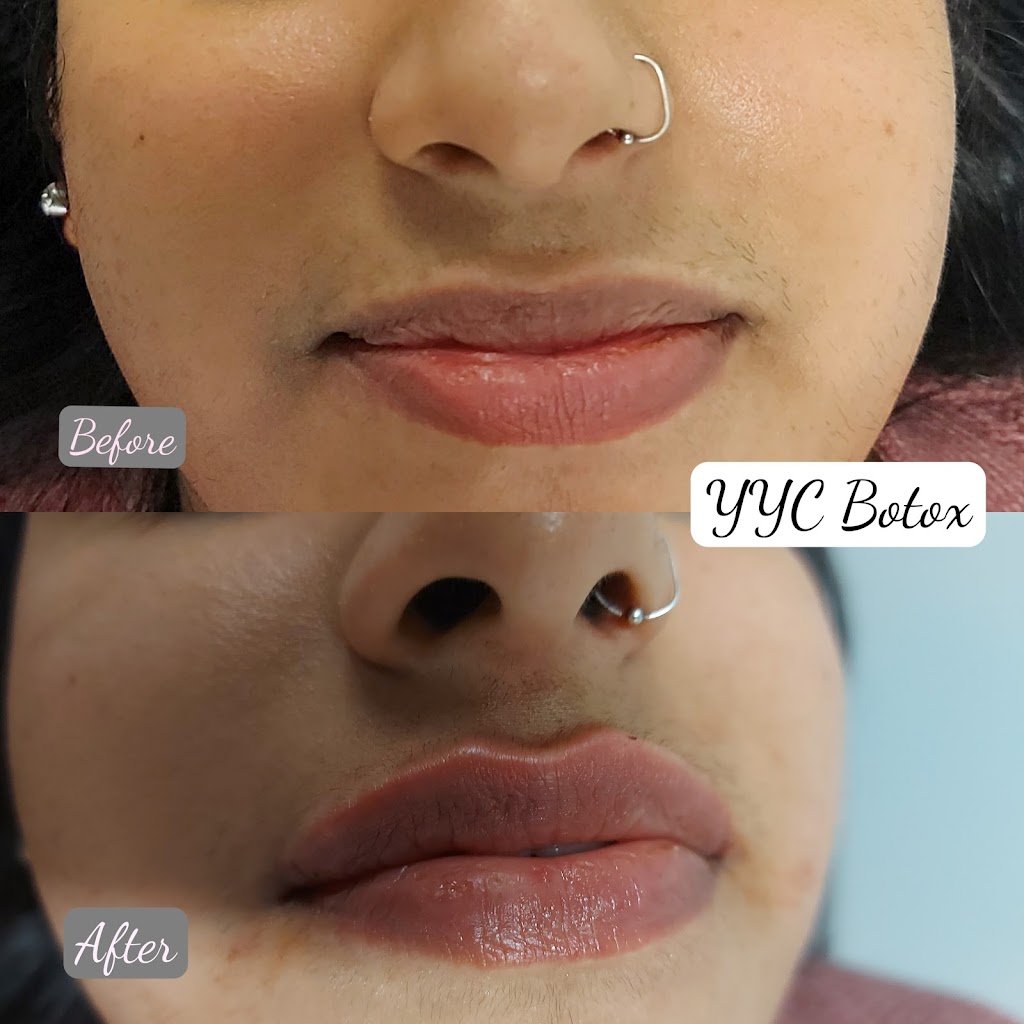YYC Botox | 1715 10 Ave SW Second floor Unit 205, Calgary, AB T3C 0K1, Canada | Phone: (403) 460-7766