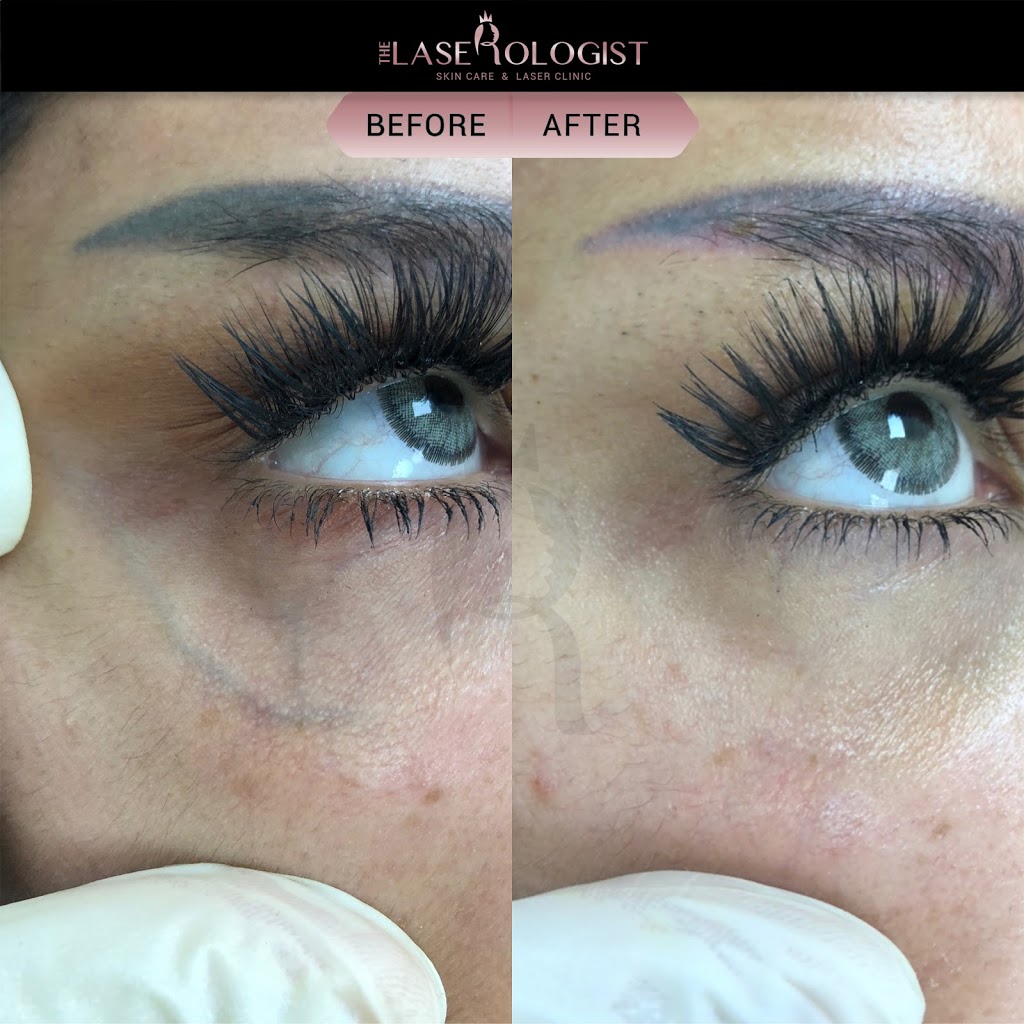 The Laserologist | 69 Bethune Ave, Hannon, ON L0R 1P0, Canada | Phone: (905) 519-7232