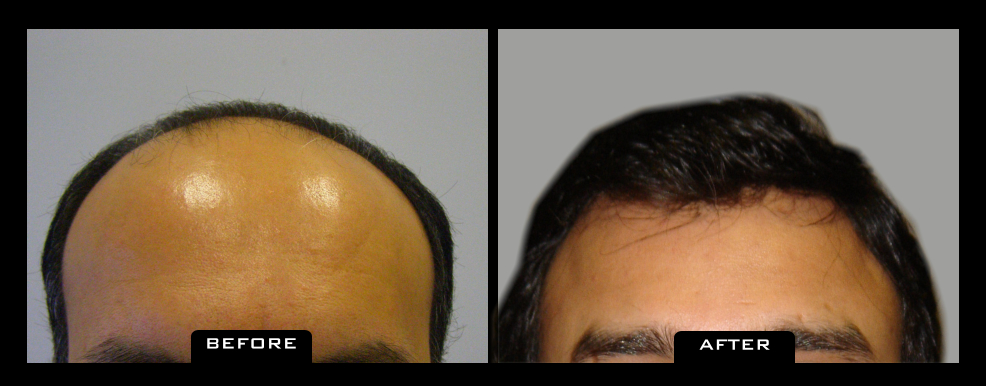 NuHair Medical Hair Transplant Centre | 5526 111 St NW, Edmonton, AB T6H 3E9, Canada | Phone: (587) 400-0344