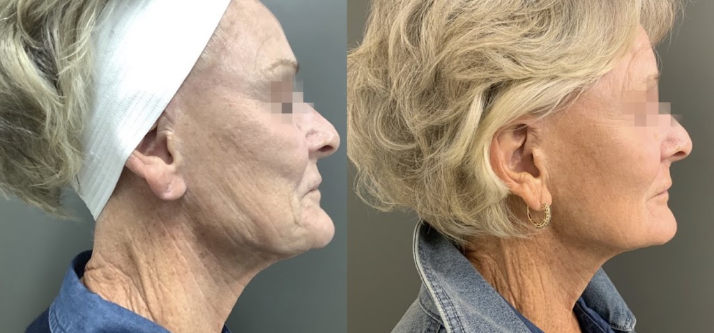 Carewell Laser Esthetics | 6490 Old Banff Coach Rd SW, Calgary, AB T3H 5R8, Canada | Phone: (604) 312-3034