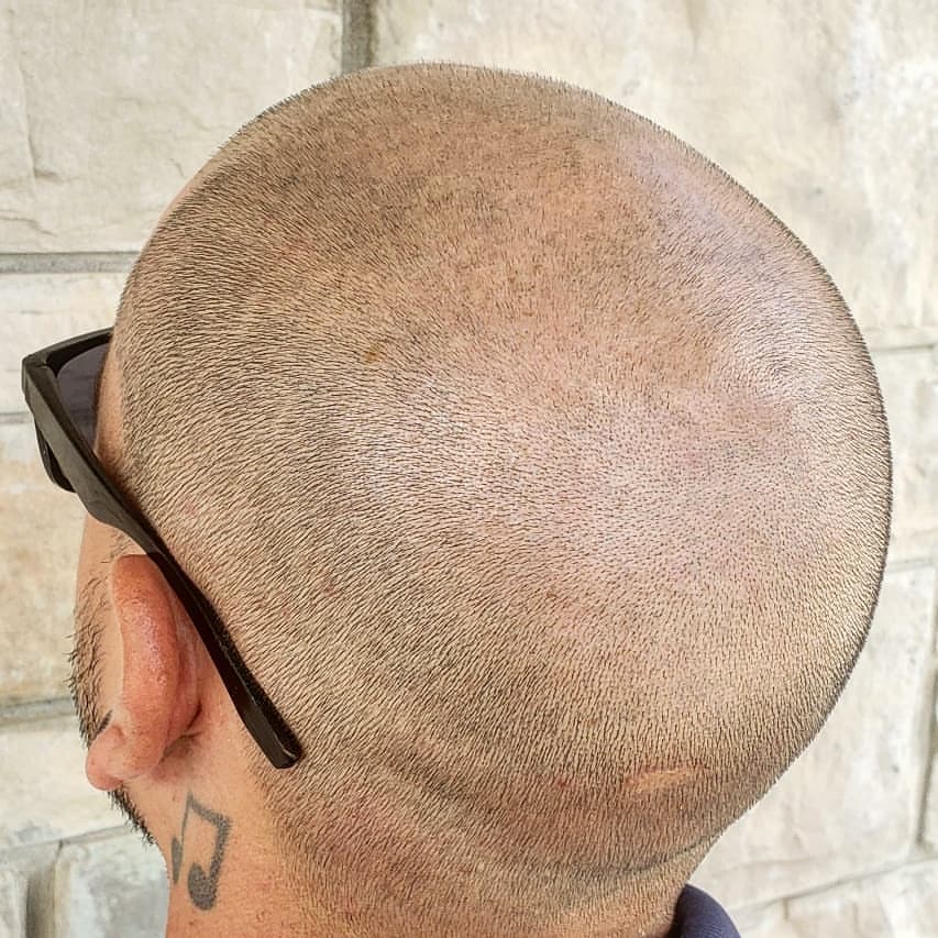 Scalp Micropigmentation by Chronic Ink - Markham | 7381 Kennedy Rd Unit #105, Markham, ON L3R 5B5, Canada | Phone: (905) 305-0311