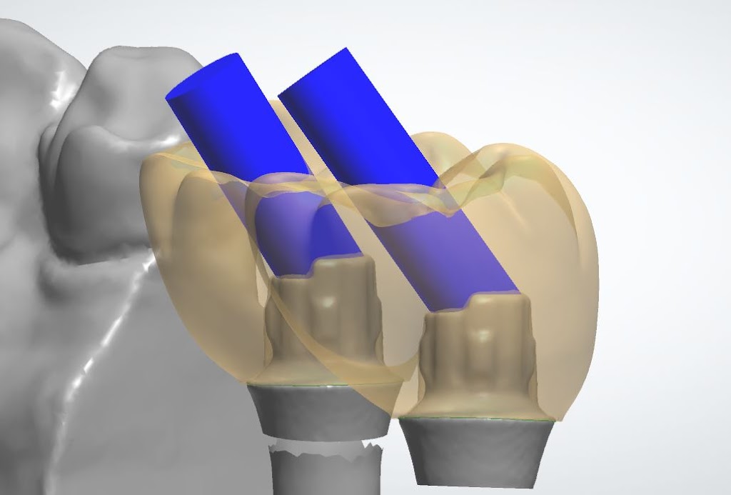 Implant Restorations Inc | 661 Sandford Rd, Uxbridge, ON L9P 1R2, Canada | Phone: (866) 802-3623