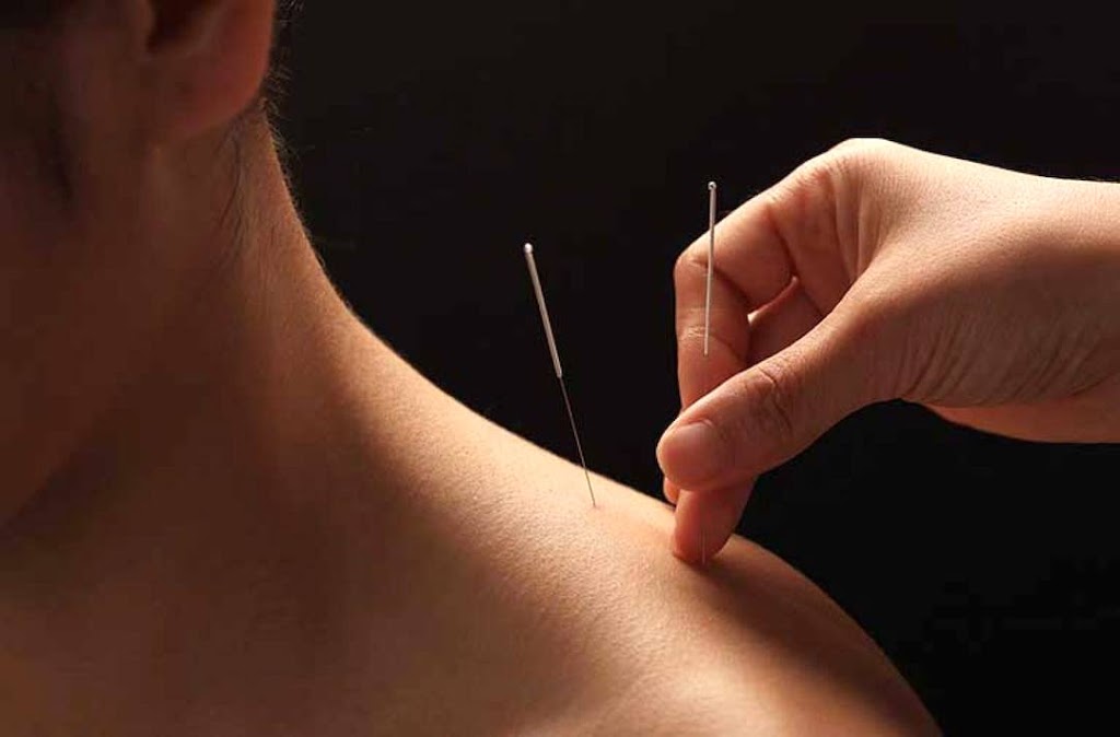 Acupuncture Isabelle Dufresne - Sherbrooke | 1871 Rue Galt O, Sherbrooke, QC J1K 1J5, Canada | Phone: (819) 943-9897