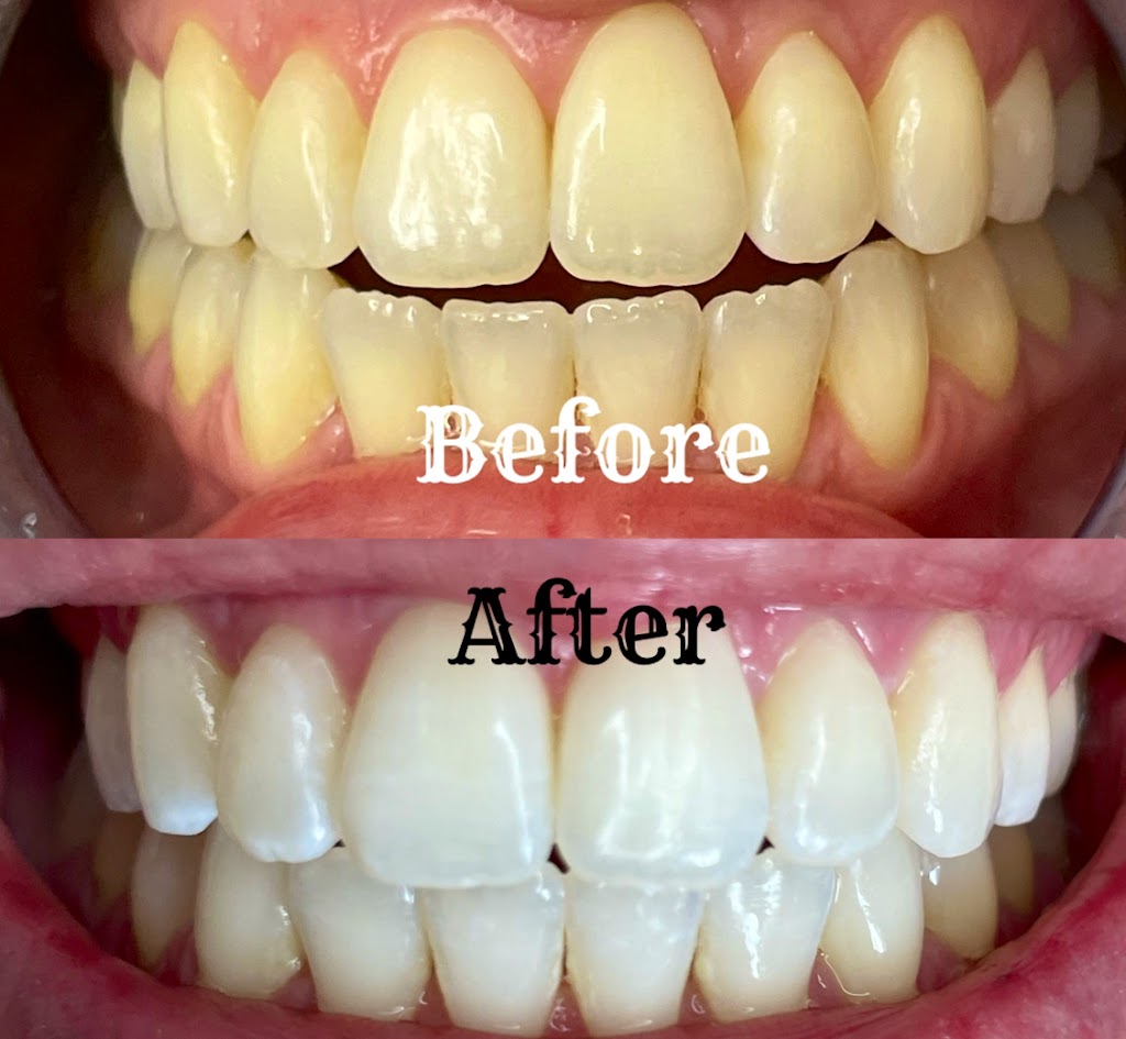 Smirk to Smile Teeth Whitening | 10 Jensen Crescent NE, Airdrie, AB T4B 1P4, Canada | Phone: (403) 404-1421
