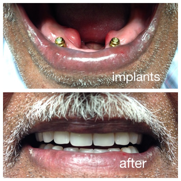 Implant Dentures | 18 Church St, Georgetown, ON L7G 2A5, Canada | Phone: (905) 877-2359