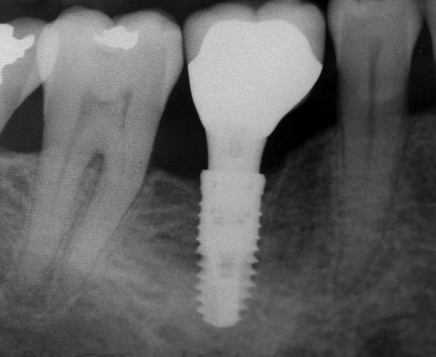 Dental Clinic Dr.Mansouri | 420 Boulevard Wilfrid-Lavigne, Gatineau, QC J9H 6W7, Canada | Phone: (819) 682-4666