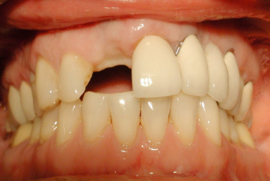 Smile Dental Implant Center - White Rock Dentists & Dental Implants | 1959 152 St, Surrey, BC V4A 9E3, Canada | Phone: (604) 531-3344