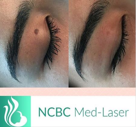 NCBC Med-laser | 5179 Yonge St #208, North York, ON M2N 5P5, Canada | Phone: (416) 222-8188