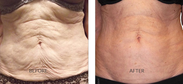MCI Cosmetic Clinic | 200 Windflower Gate Unit 700, Woodbridge, ON L4L 9L3, Canada | Phone: (905) 856-2100 ext. 205