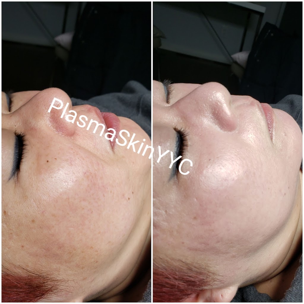 Plasma Skin YYC | 152 Walden Rise, Calgary, AB T2X 0N4, Canada | Phone: (403) 710-5381