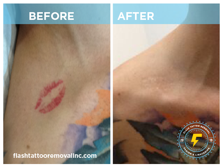 FLASH Tattoo Removal Calgary | 1530 9 Ave SE, Calgary, AB T2G 0T7, Canada | Phone: (403) 978-5488