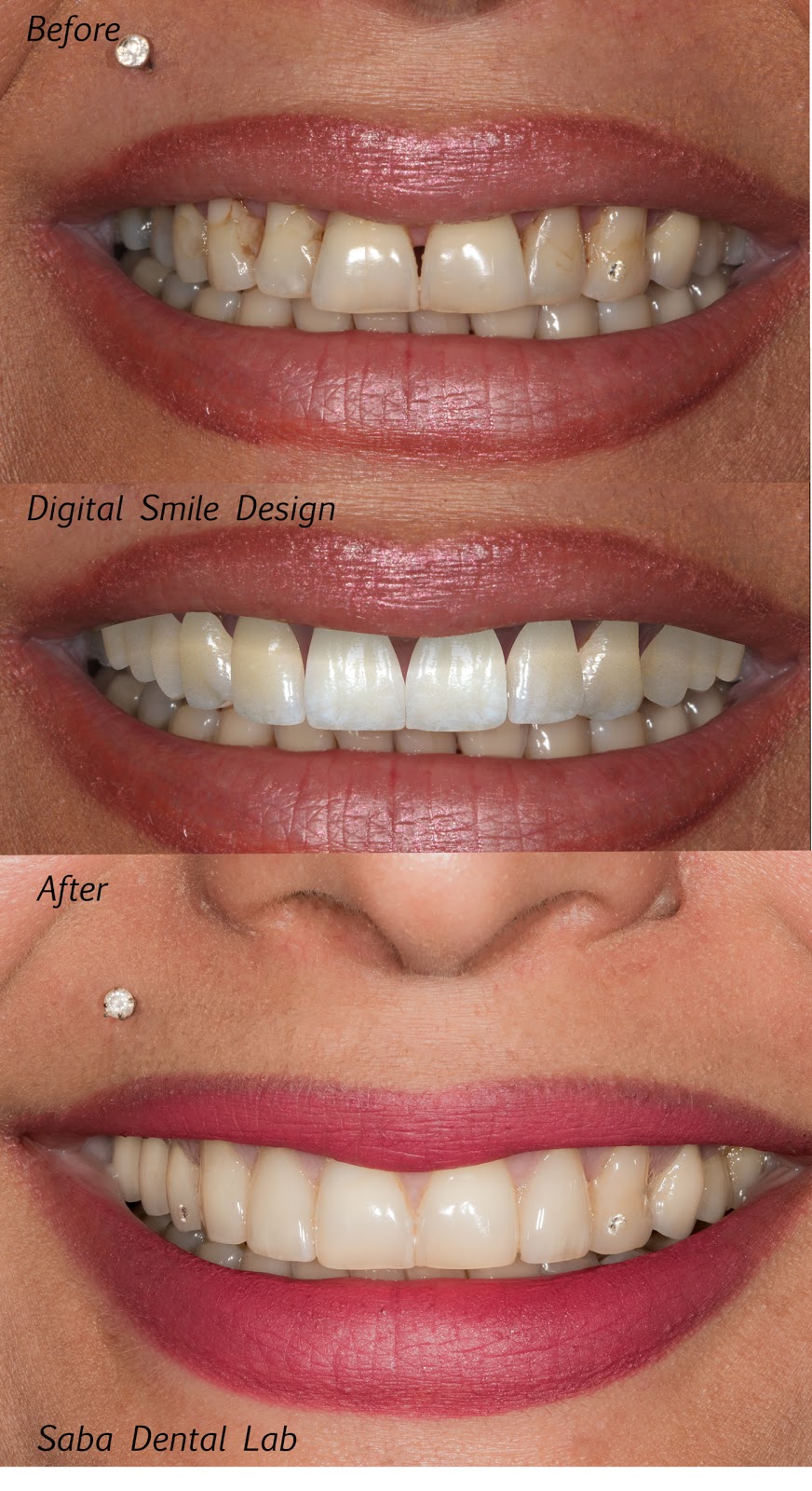 Saba Dental Lab | 2268 Park Crescent, Coquitlam, BC V3J 6T4, Canada | Phone: (604) 320-2530