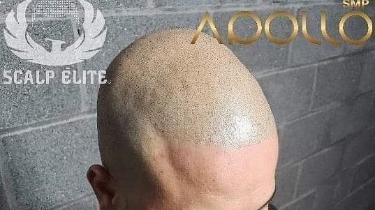Micropigmentation Capillaire Scalp Élite Sherbrooke | 121 QC-216, Stoke, QC J0B 3G0, Canada | Phone: (819) 434-7477