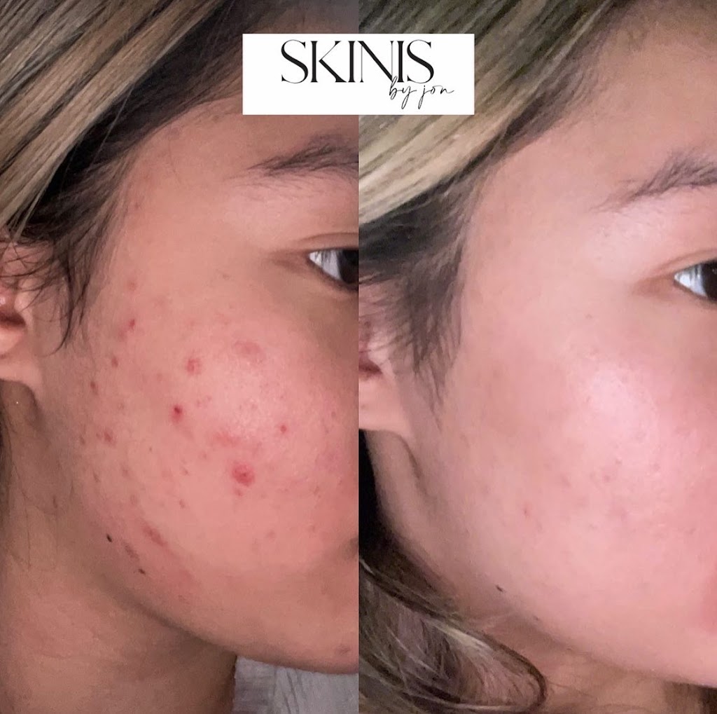 Skinis Medical Aesthetics | New Brighton, Calgary, AB T2Z 1G9, Canada | Phone: (403) 891-5619