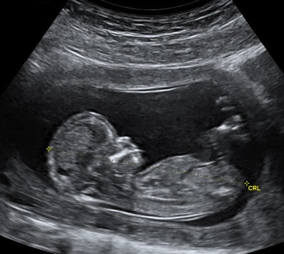Baby Peek Ultrasound Inc | 28016 Township Rd 540, Spruce Grove, AB T7X 3V4, Canada | Phone: (780) 901-8313