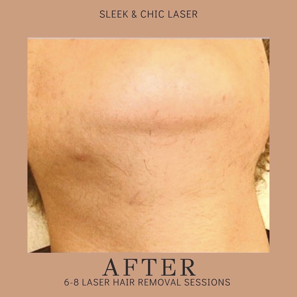 Sleek & Chic Laser Studio | 1720 Eglinton Ave E, North York, ON M4A 2X8, Canada | Phone: (647) 528-4103