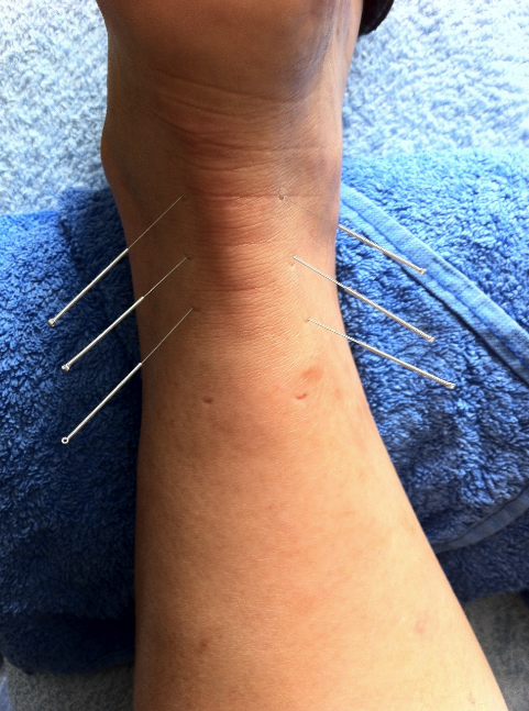 Acupuncture Marylène Fournel - St-Jérôme | 674 Boul. St.-Antoine, Saint-Jérôme, QC J7Z 3B9, Canada | Phone: (450) 504-1113