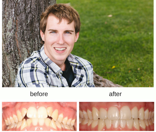 Hometown Orthodontics | 228 Lakeshore Rd W Suite 3, Mississauga, ON L5H 1G6, Canada | Phone: (905) 278-6513