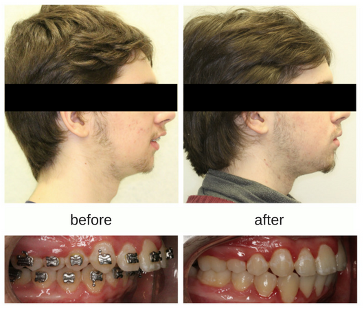 Hometown Orthodontics | 228 Lakeshore Rd W Suite 3, Mississauga, ON L5H 1G6, Canada | Phone: (905) 278-6513