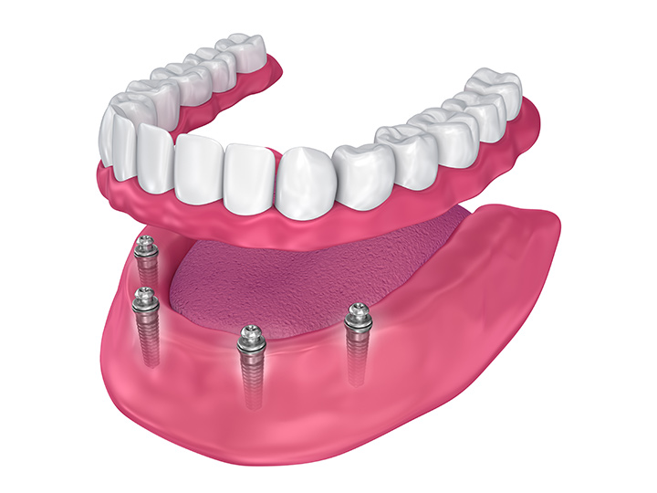 Dignard & Dignard | 340 Boulevard Gagné, Sorel-Tracy, QC J3P 5V8, Canada | Phone: (450) 743-1977