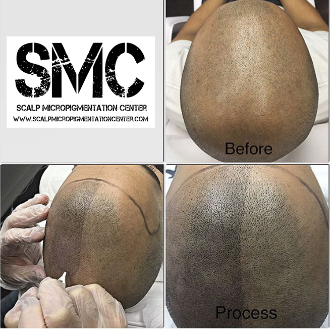 Scalp Micropigmentation Training Center Head Office | 19 Aerodrome Crescent #301, East York, ON M4G 4J3, Canada | Phone: (844) 877-2257