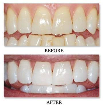 The Smile Spa - Professional Teeth Whitening & Esthetics | 787 Everton Way, Gloucester, ON K1V 1Y3, Canada | Phone: (613) 862-6989