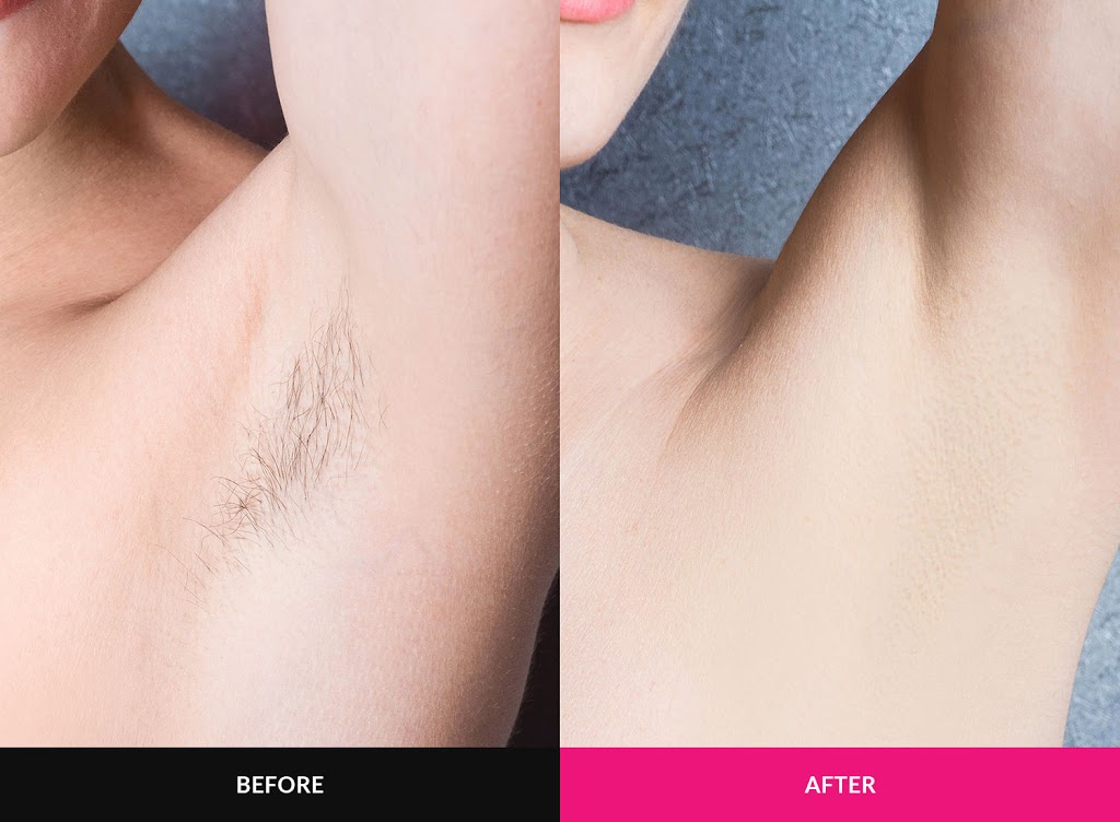 Alyssum Laser & Skin Care - Laser Hair Removal Calgary | 11 Cityscape Mews NE, Calgary, AB T3N 1A6, Canada | Phone: (403) 702-3878