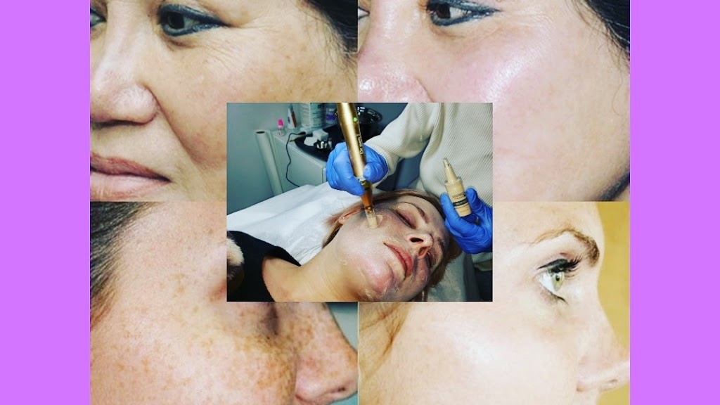 Plasma Skin YYC | 152 Walden Rise, Calgary, AB T2X 0N4, Canada | Phone: (403) 710-5381