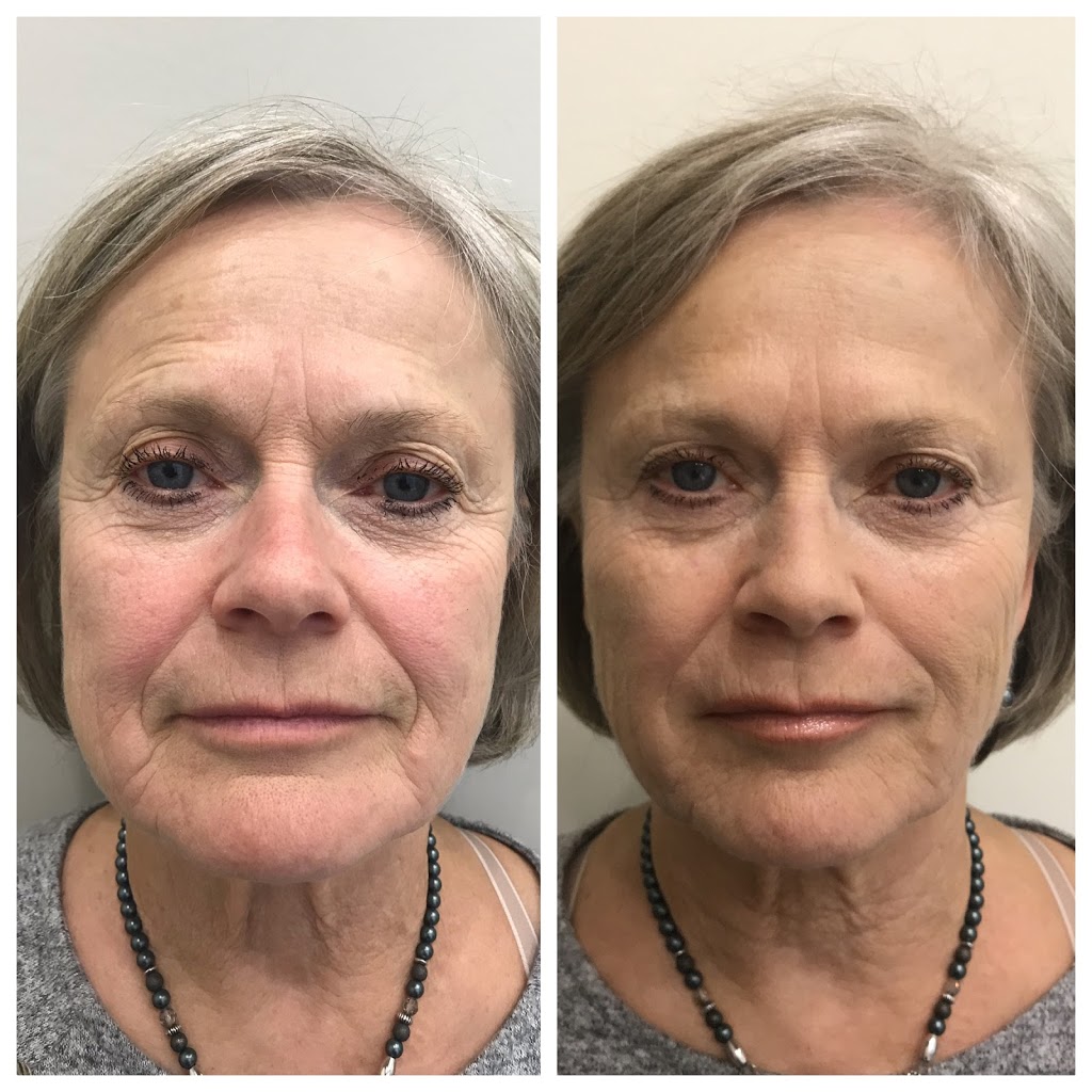 Clinique Medispa | 201 Rue Champlain Local 202, Bromont, QC J2L 3B2, Canada | Phone: (450) 726-9050