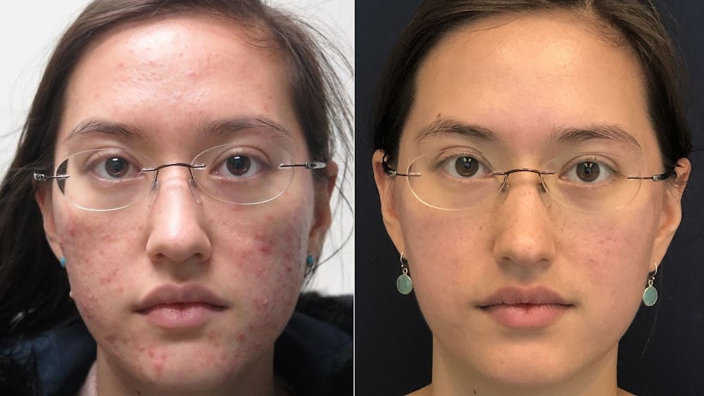 White Rock Skin and Laser Clinic | 15850 26 Ave #101, Surrey, BC V3Z 2N6, Canada | Phone: (778) 545-1925
